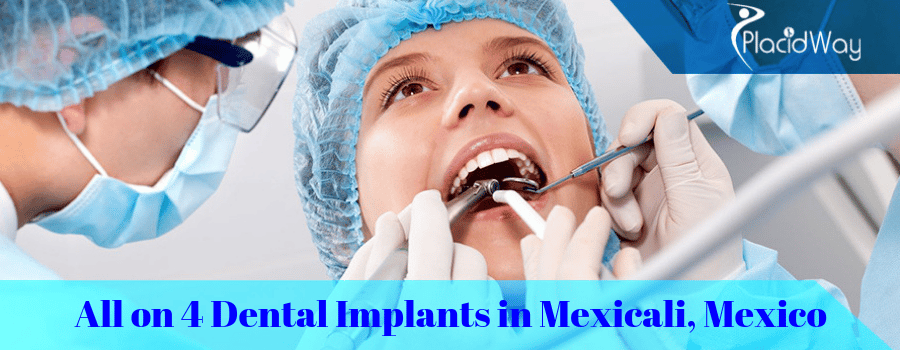 Cost of 4 on 1 Dental Implants in Mexico
